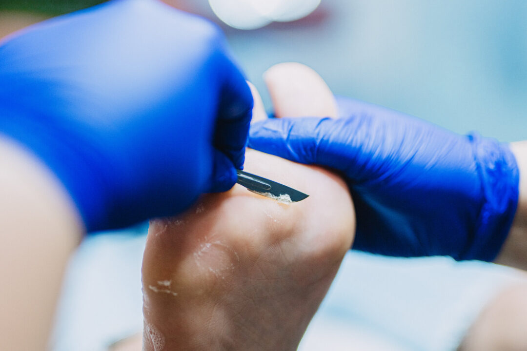 Pedicure Podologiczny - praca skalpelem i dłutem